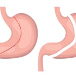 Gastric Sleeve Surgery