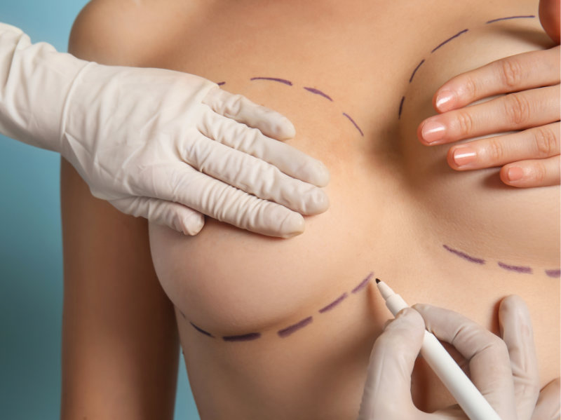 Breast Lift Surgery