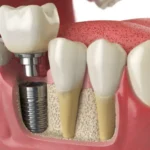 Dental Implant Procedures
