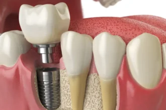 Dental Implant Procedures