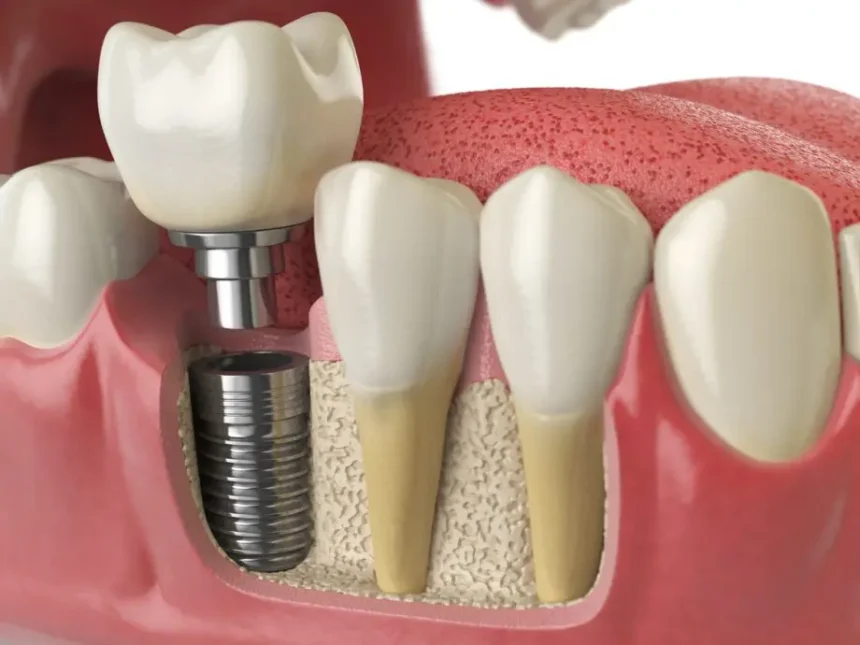 Dental Implant Procedures