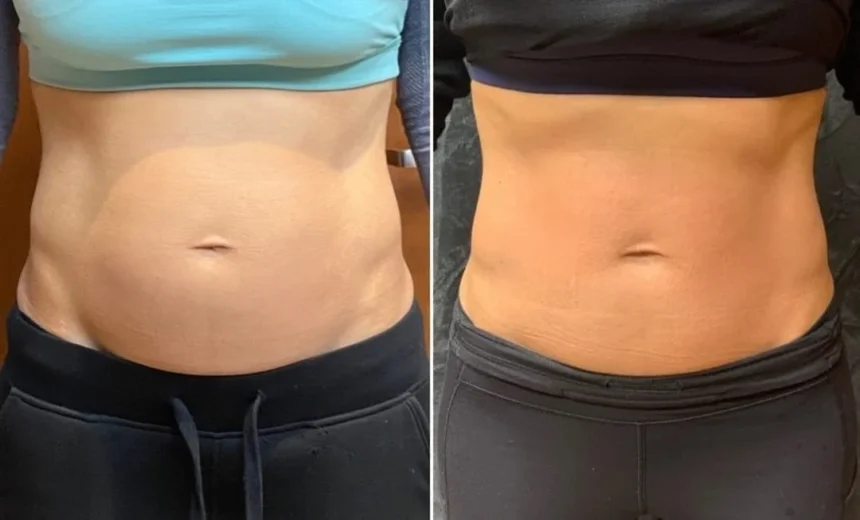 Evolve X for Comprehensive Body Contouring Results