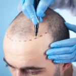 Hair Transplant Options
