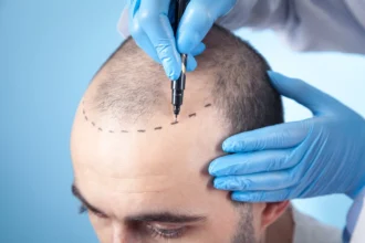 Hair Transplant Options