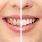 Kor Whitening Process