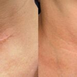 Microneedling for Scarring Treatment