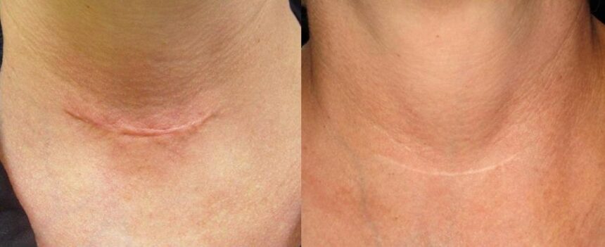 Microneedling for Scarring Treatment