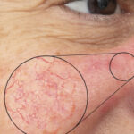 Spider Vein Treatments