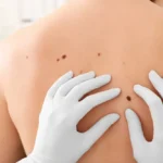 Squamous Cell Carcinoma