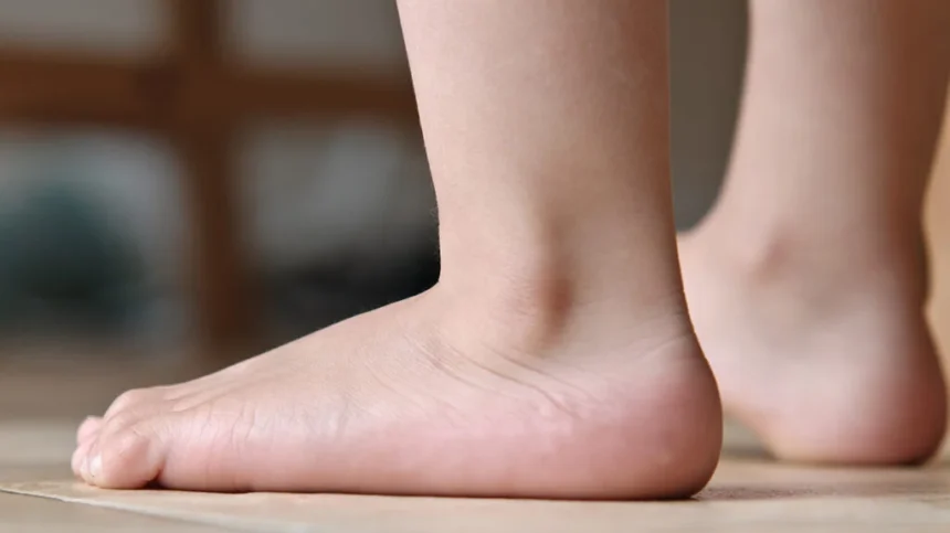 Treat Flat Feet