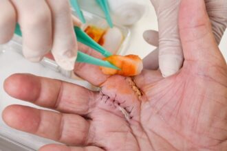 Wound Care Management