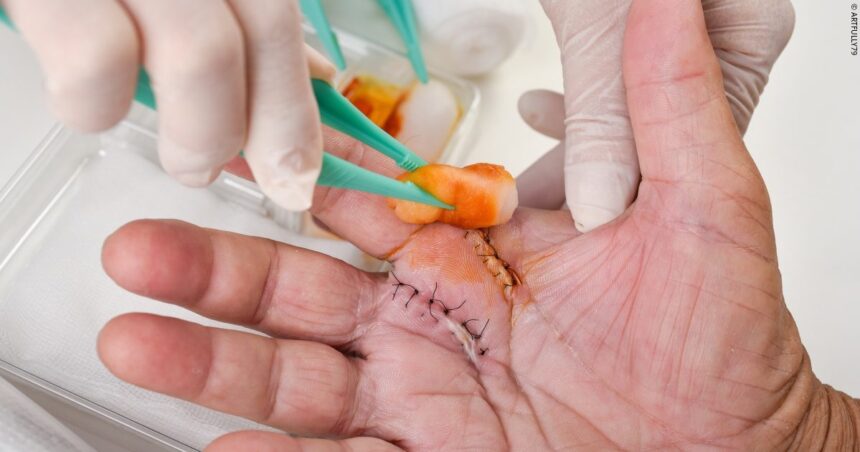 Wound Care Management