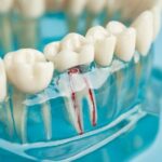 Tooth Decay and Root Canal Treatment