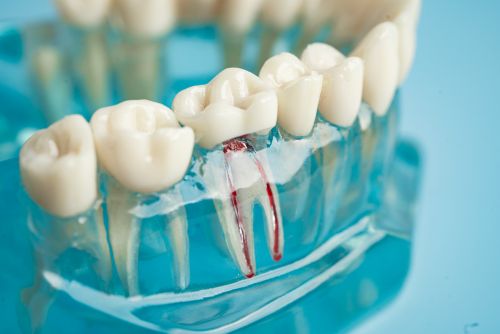 Tooth Decay and Root Canal Treatment