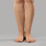 Chronic Venous Insufficiency Symptoms